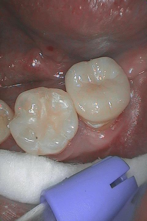 cavity side of molar